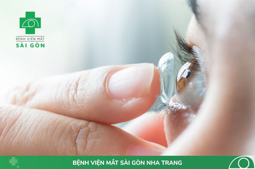 [HỎI & ĐÁP] ĐIỀU TRỊ CẬN THỊ VỚI KÍNH ÁP TRÒNG CỨNG ORTHO-K  